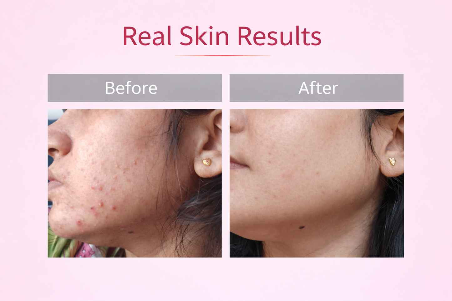 SNAILTRAIL Advanced Dark Spots & Hyperpigmentation Corrector Face Serum | Reduces Acne Marks & Melasma | 10% Niacinamide, 5% Snail Mucin & 2% NAG | Evens Skin Tone & Brightens Dull Skin | With Licorice & Manjistha | For All Skin Types – 30ml